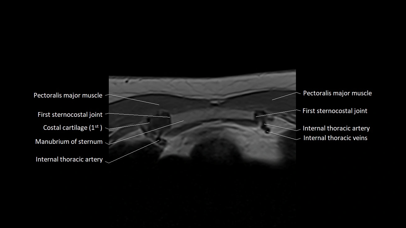 MRI sternum and sternoclavicular joint labeled axial anatomy image 9.webp